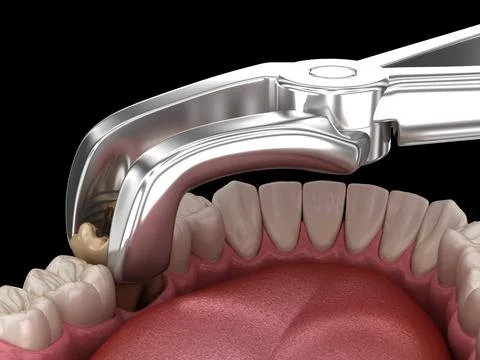 Extraction of Molar tooth damaged by caries. Medically accurate tooth 3D illu Stock Illustration