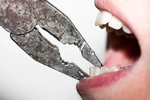 Extractions with pliers Foto stock