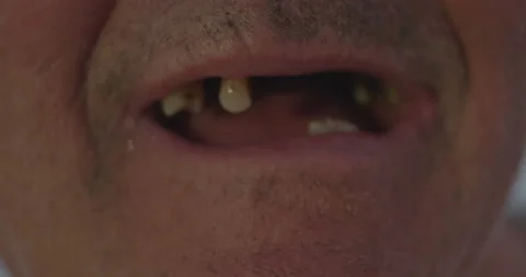 Extreme Bad Denture Stock Footage 139980064