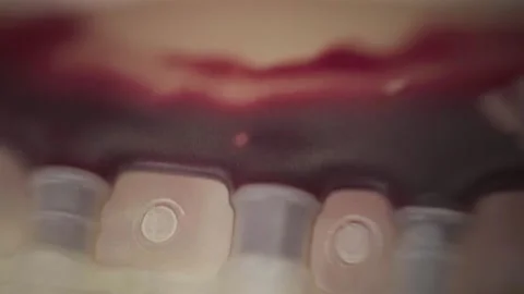 Extreme Close Up of Blood Bag During Donation Stock Footage 345551129