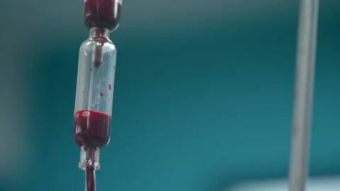 Extreme close-up blood drops from filter to drip chamber at a hospital in Karach Stock Footage 130476469