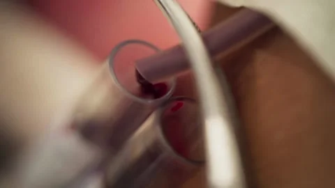 Extreme Close Up of Blood During Donation Stock Footage 345551089