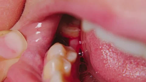 Extreme close-up of a bloody socket after a tooth extraction Stock Footage 346472176