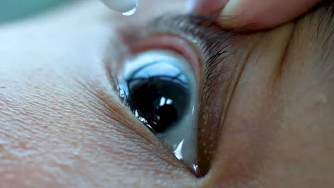 Extreme close up of eye drops falling into human eye for medical treatment. Stockbeeldmateriaal 333488546