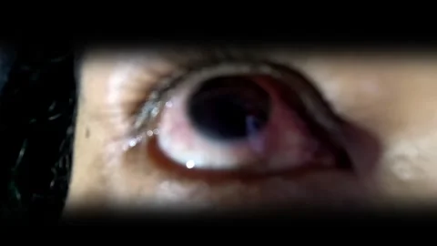 Extreme Close up of Inflamed Human Eye Showing Redness and Irritation Vidéo 342339581