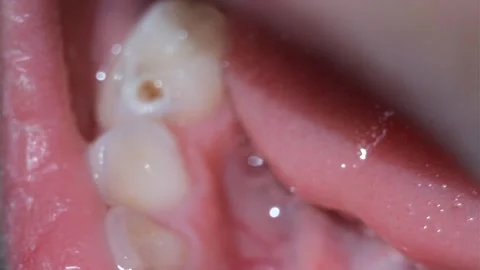 Extreme Close Up of a Lower Right First Molar Cavity of a 4-Year-Old-Girl Stock Footage 315285665