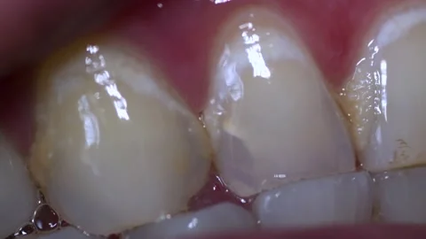 Extreme close up of stained teeth with tartar Stock Footage 156533459