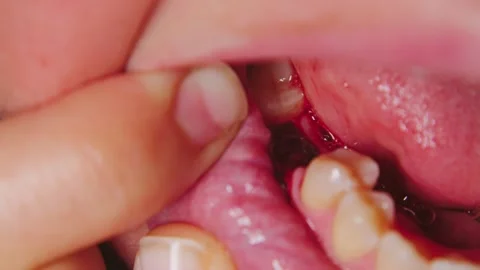 Extreme close-up of a tooth extraction site Stock Footage 346472171