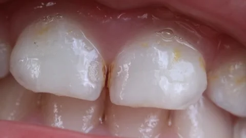 Extreme Close Up of Upper Central Incisors' Cavities of a 4-Year-Old Girl Stock Footage 315455590