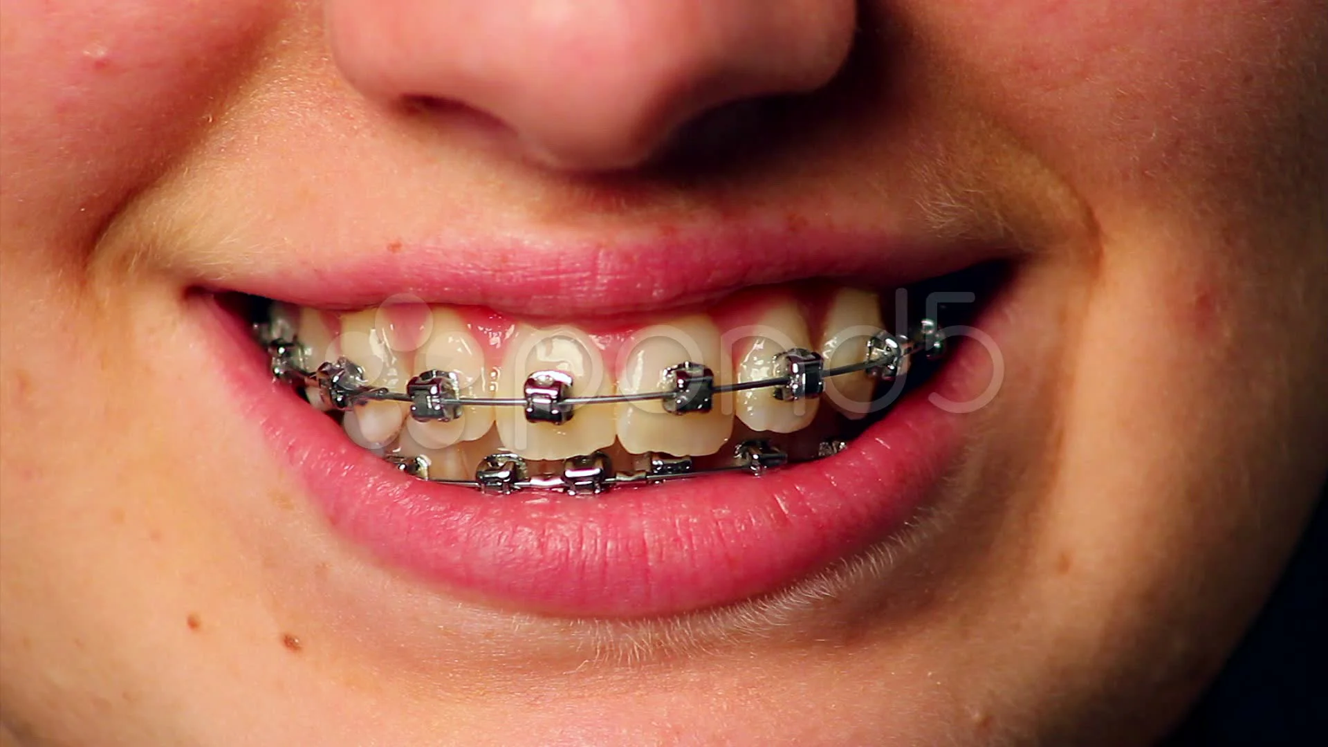 Extreme close up of young girls mouth with braces