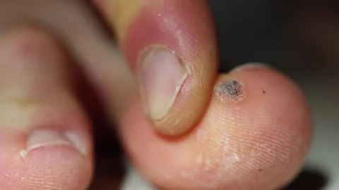 Extreme closeup of a human toe with a rough wart and cracked nail dry textured s Stock Footage 312979297