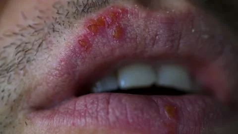 Extreme closeup of lips with cold sore Stock Footage 156938568