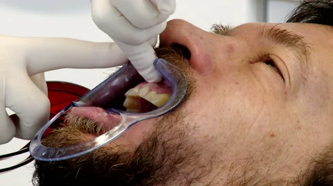 Extreme closeup of man starting teeth whitening Stock Footage 45990027