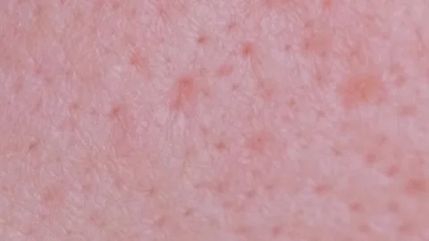 Extremely close-up technology of problem skin of a person with large own pores Stock Footage 250114557