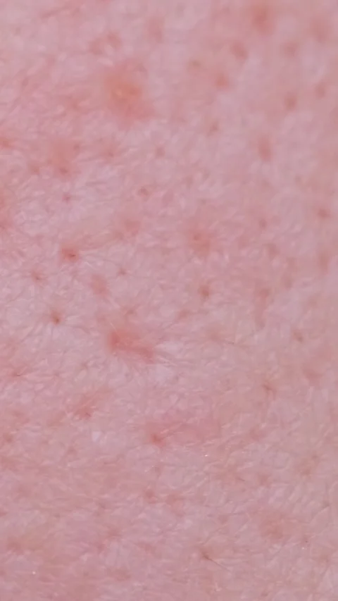 Extremely close-up technology of problem skin of a person with large own pores Stock Footage 250385013