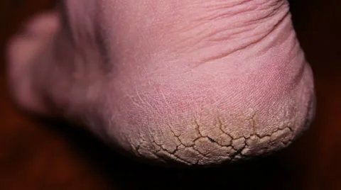 Extremely Cracked Heels Stock Footage 61831657