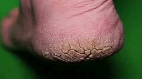 Extremely Dry Cracked Heels Stock Footage 61832316