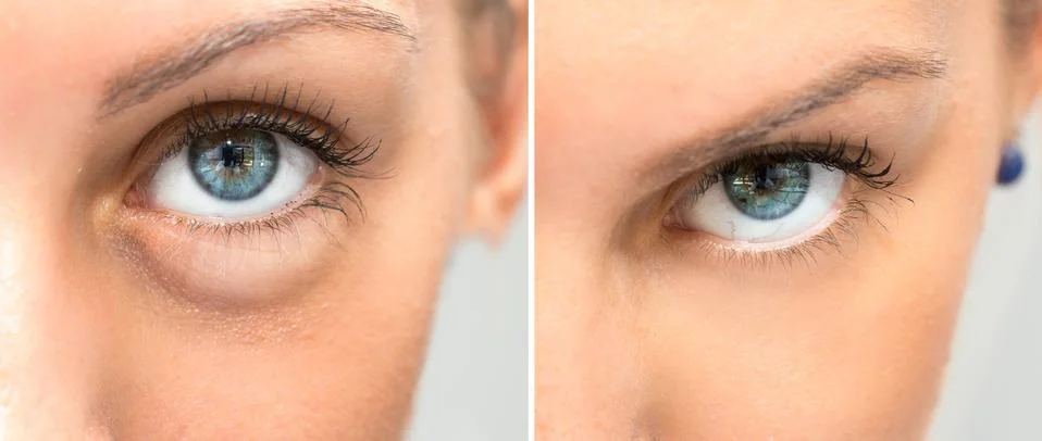 Eye with and without swelling before and after cosmetic treatment 스톡 사진