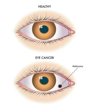 Eye cancer Stock Illustration
