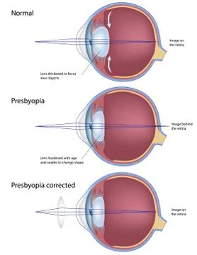 Eye condition : presbyopia Stock Illustration