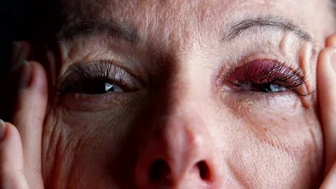 The eye with conjunctivitis is marked redness of the eyelid  Stock Footage 301313807