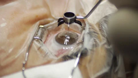 Eye correction surgery Stock Footage 133009487