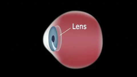 Eye disease - Cataract Video stock 11413745