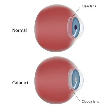 Eye disease - Cataract Stockillustratie