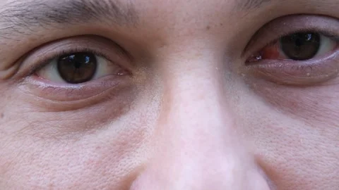 Eye disease, Pterjium Stock Footage 257697984