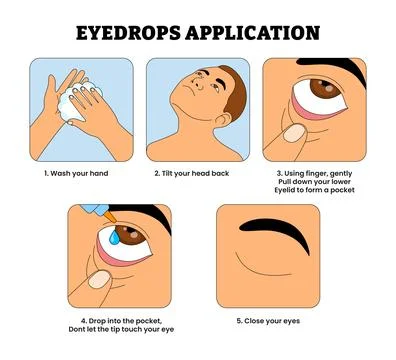 Eye Drops Application Procedure Process Poster Diagram Healthcare, Educatio.. Stock Illustration