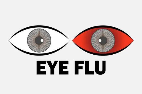 Eye flu infection concept vector illustration Illustration