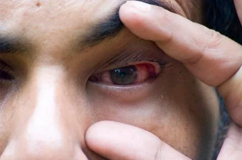 Eye Flu Stock Photos