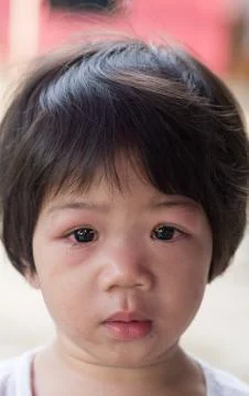 Eye with infection. Foto stock