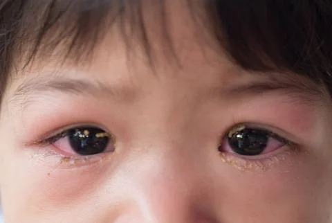 Eye with infection. Stock Photos