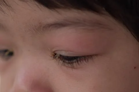 Eye with infection. Foto stock