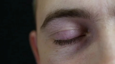 The eye of a man close-up. The man has a red eye for fatigue and stress. Stock Footage 86800725