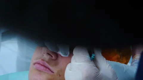 Eye plastic surgery. A surgeon removing piece of skin from eyelid Stock Footage 145603103