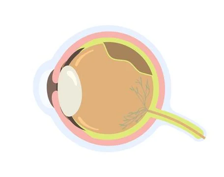 Eye With Retinal Detachment Vector Illustration Stock Illustration