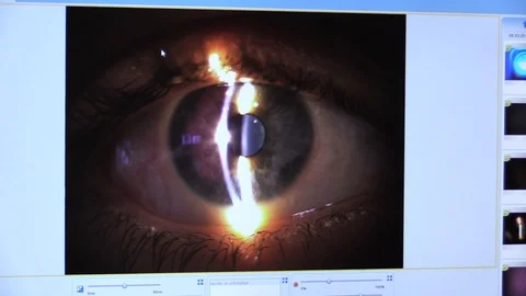 Eye on a screen during an ophthalmic consultation Stock Footage 112336560