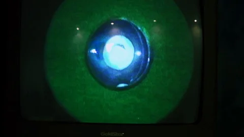 Eye Screen for lasik surgery Vídeo Stock 123719692