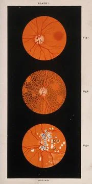 The eye, as seen through a microscope: three figures. Colour lithograph, ca.. Illustrazione stock