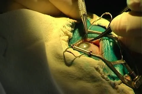 Eye surgery Stock-Footage 10738574