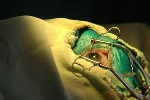 Eye surgery Stock-Footage 10738590