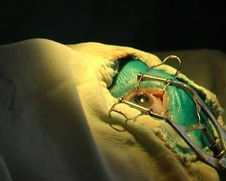 Eye surgery Stock Footage 10738594
