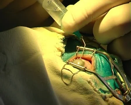 Eye surgery Stock Footage 10738596