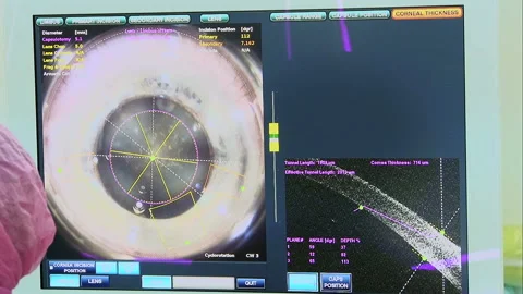 Eye surgery with laser beam Stock Footage 124307285