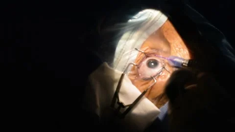 Eye surgery in the operating room Stock Footage 155028388