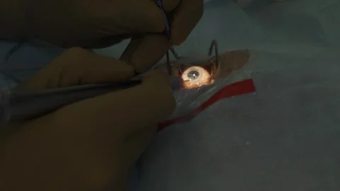 Eye surgery, shooting video from hands Vídeos de archivo 322617896
