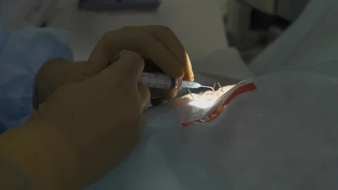 Eye surgery, shooting video from hands Vídeos de archivo 322618525