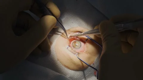 Eye surgery, shooting video from hands Vídeos de archivo 322621801